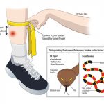 ক্ষতস্থান যেভাবে বাঁধতে হয়।