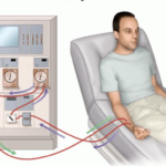 hemodialysis